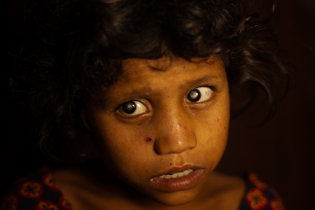 Cataracts are the leading cause of needless blindness in children. (Image: Urmila Tamang / Tej Kohli & Ruit Foundation)